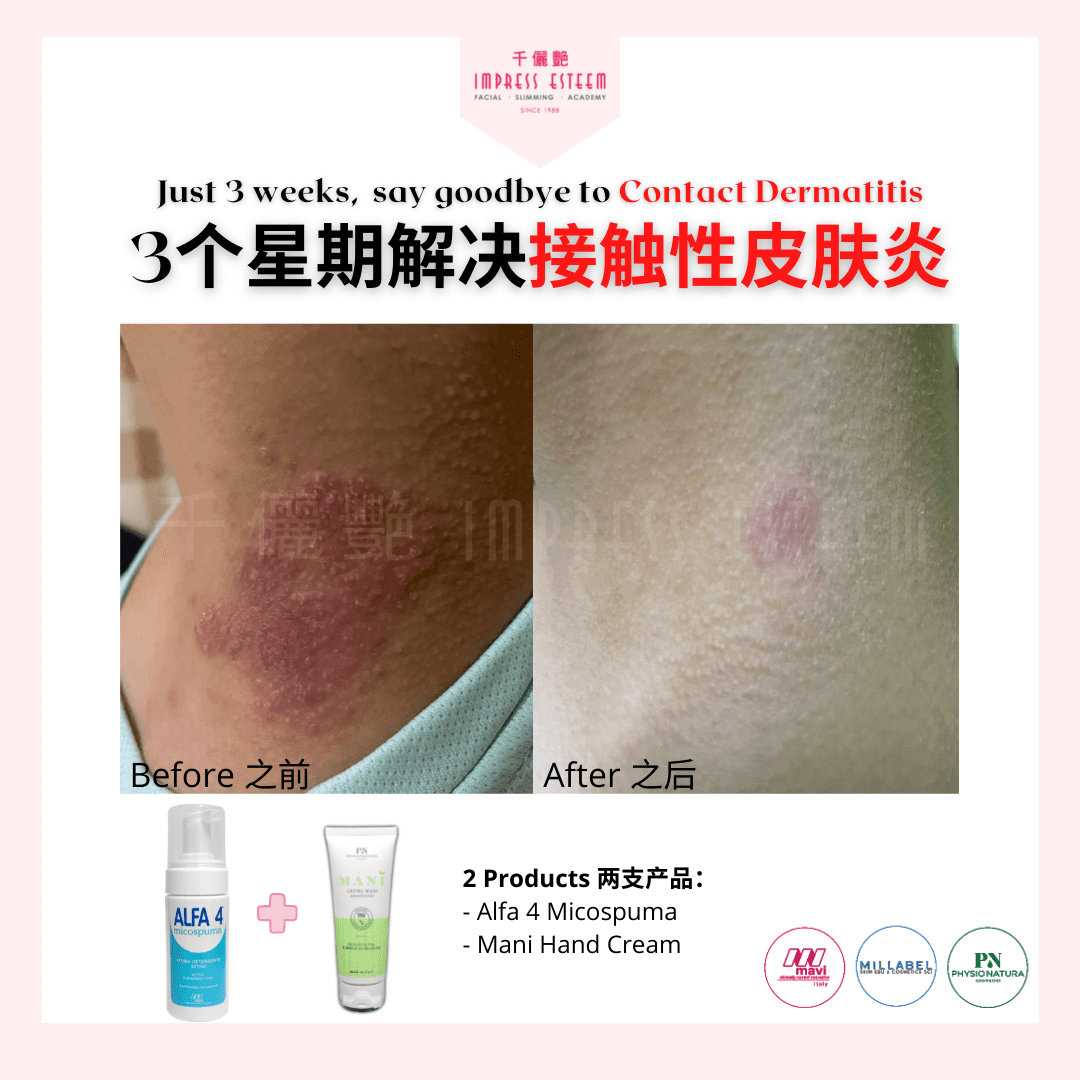 Say Goodbye To Contact Dermatitis In 3 Weeks 3个星期解决接触性皮肤炎