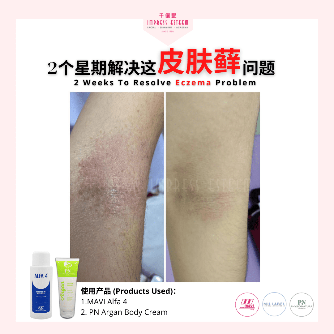 Say Goodbye To Eczema In Just 2 Weeks 只需2个星期，向皮肤藓说byebye✨✨