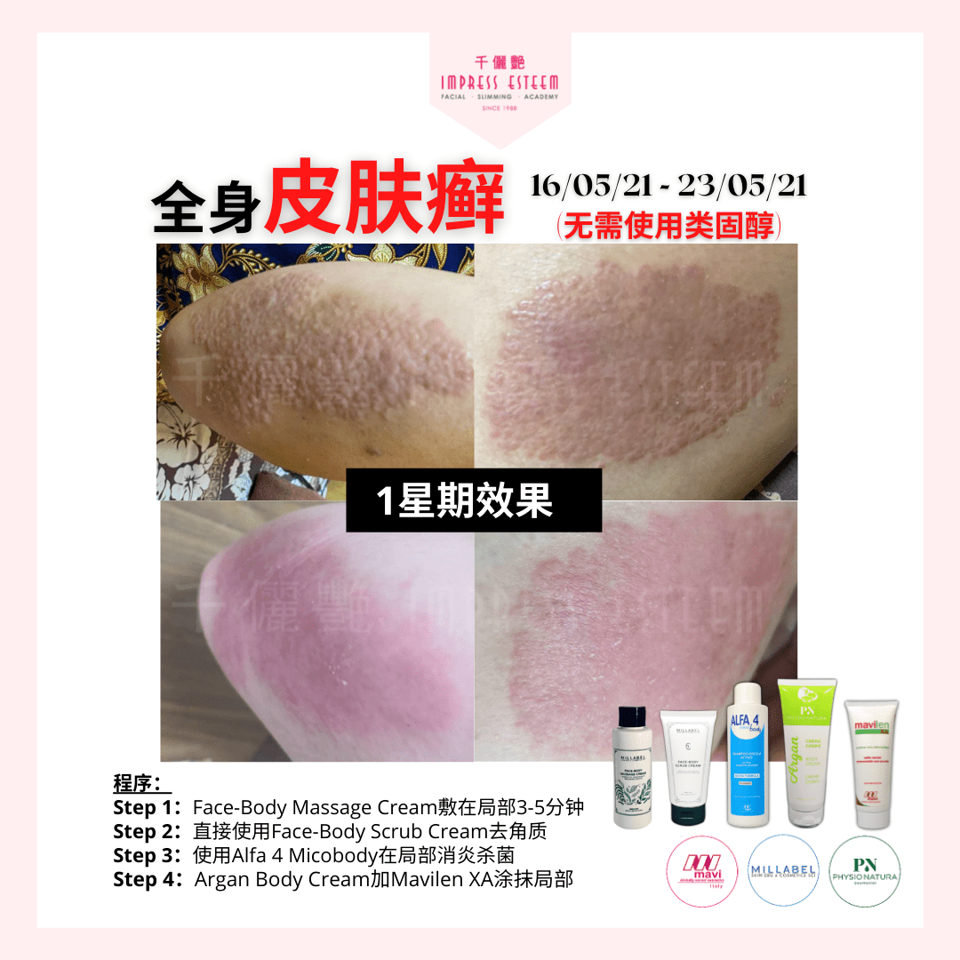 Just 1 Week, Say Goodbye To Eczema 全身皮肤藓，只需一星期，效果佳